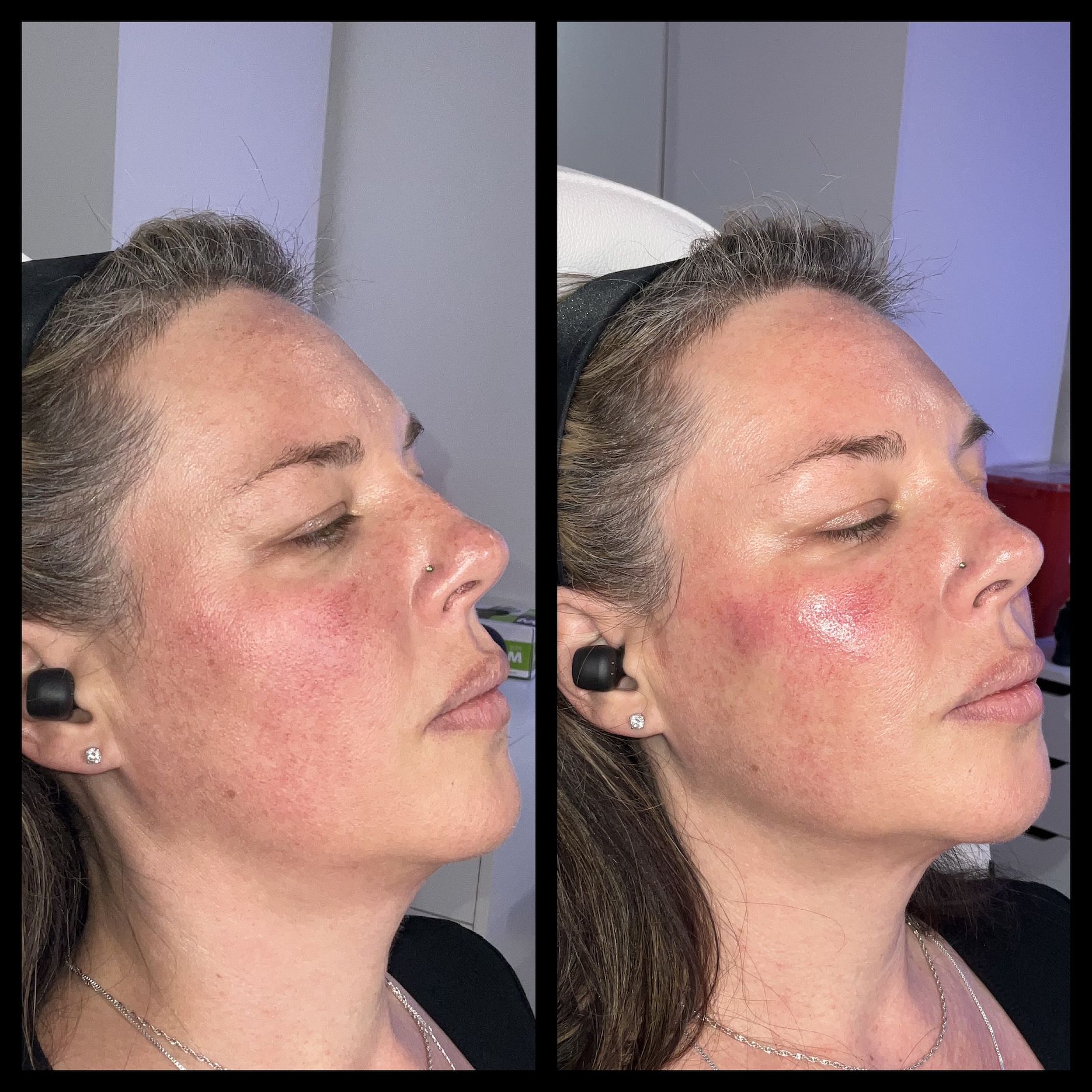 Lip filler in Baltimore, MD