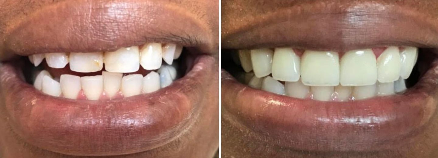 Before and after