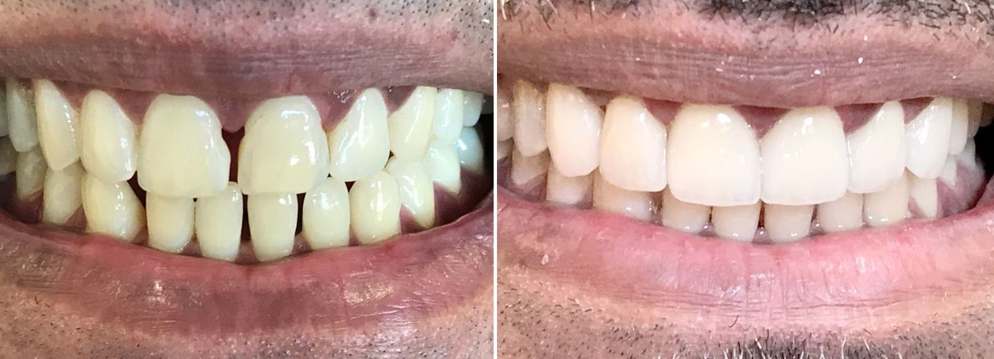 before and after