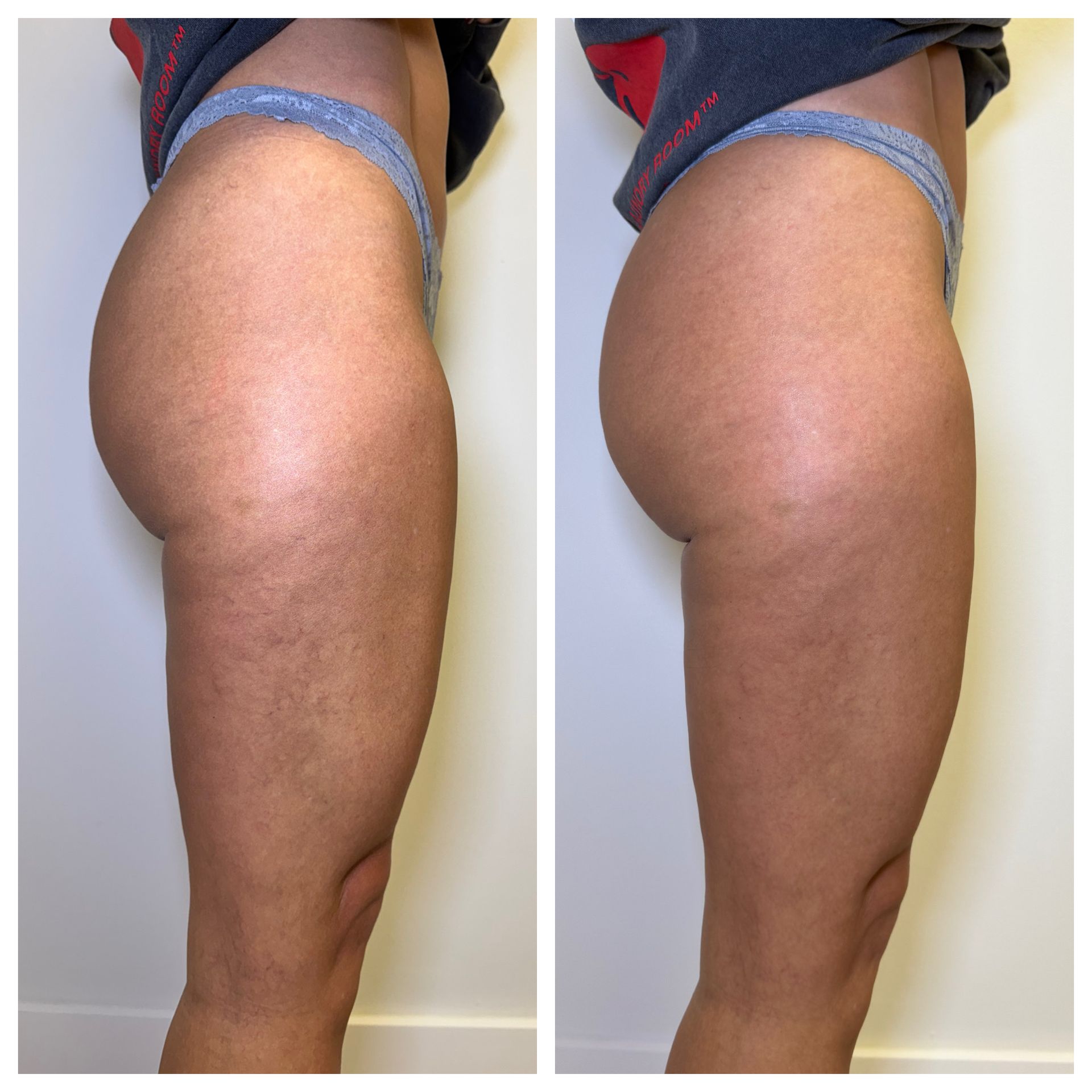Three rear views of legs and buttocks with cellulite. T-Shape 2 cellulite smoothing and body contouring