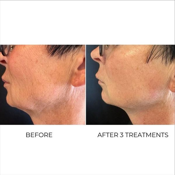 T-Shape 2 jawline contouring before and after