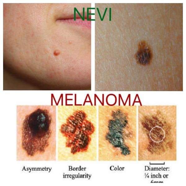 Scrivania con tabella di prevenzione del melanoma, strumenti, crema solare, cappello e microscopio.