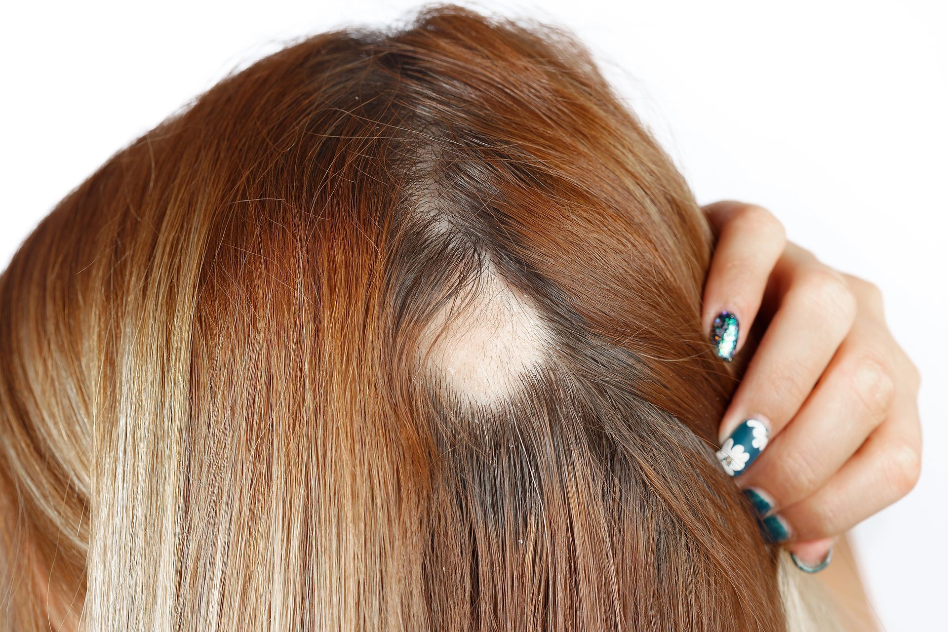Testa di donna con una chiazza calva visibile attraverso i radi capelli castano chiaro, mano che tocca la testa.