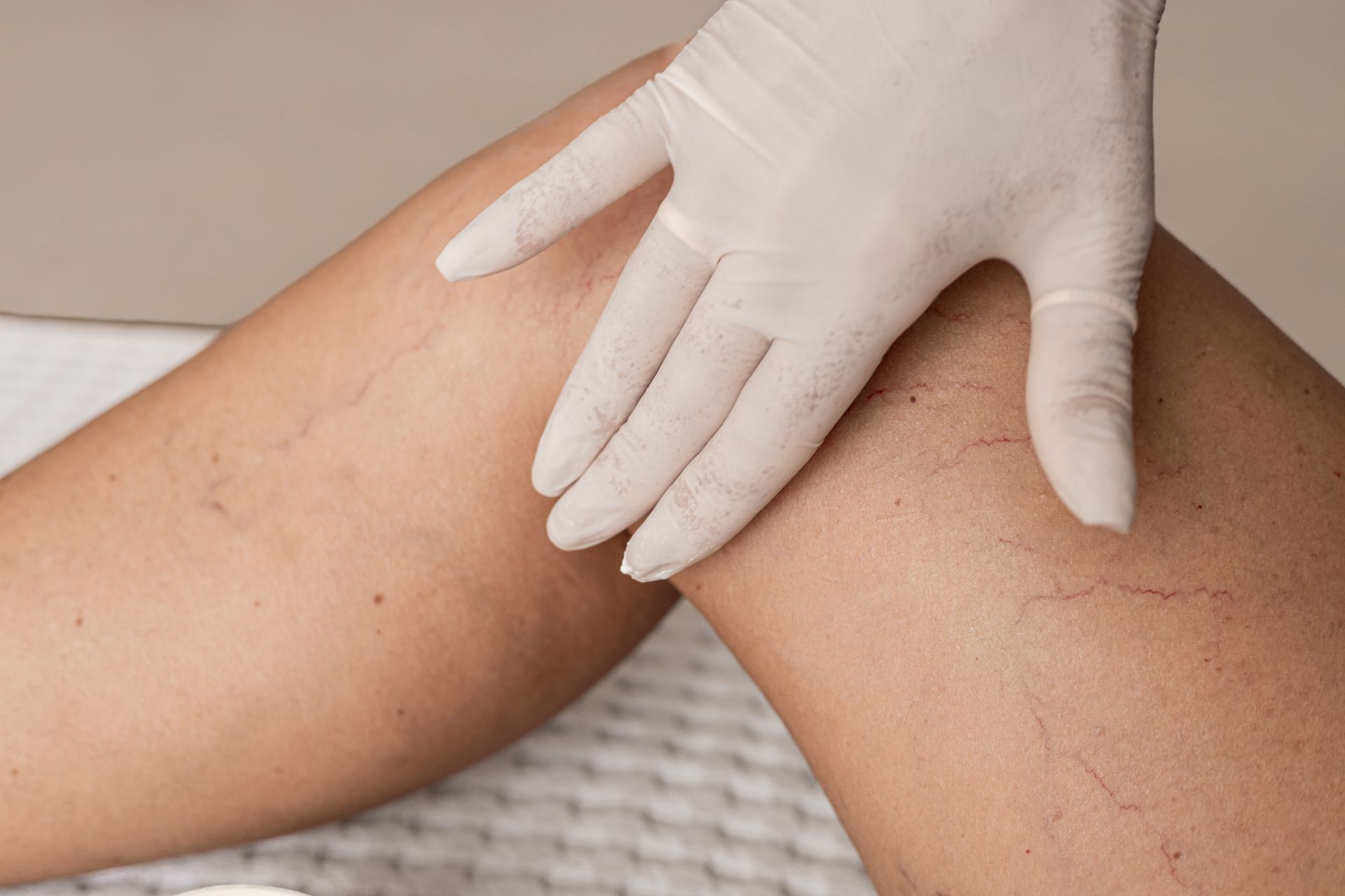 Gloved clinician examining visible varicose veins on a leg.