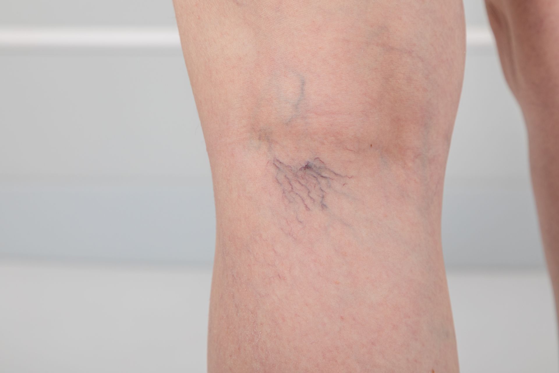 Close-up of spider veins and varicose veins on a person's leg against a gray background.