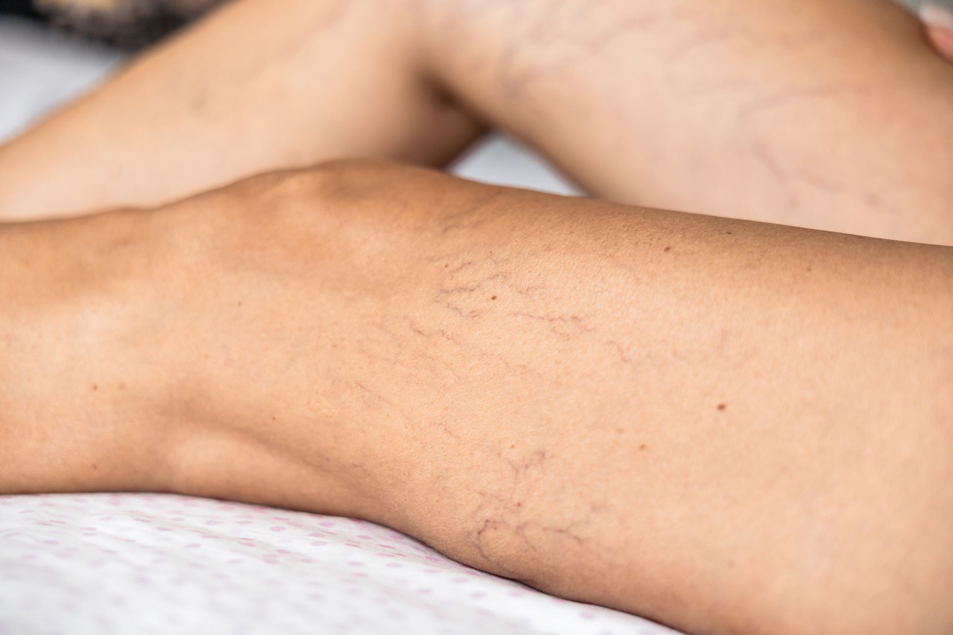 Spider veins visible on the back of a person's thigh and leg resting on a treatment table.