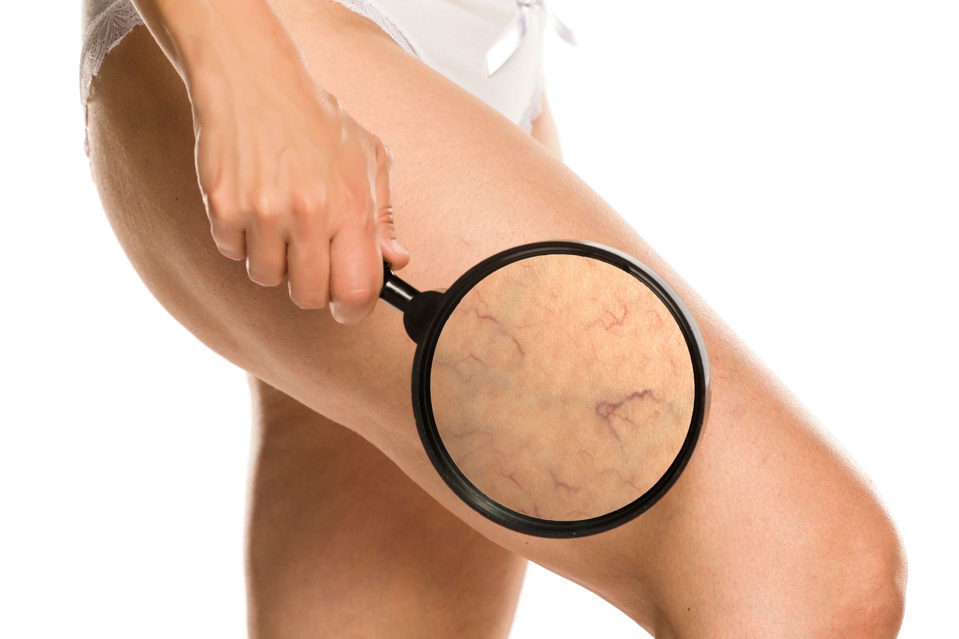 Woman holding magnifying glass over leg showing visible varicose veins on thigh. Woman holding magnifying glass over leg showing visible varicose veins on thigh.