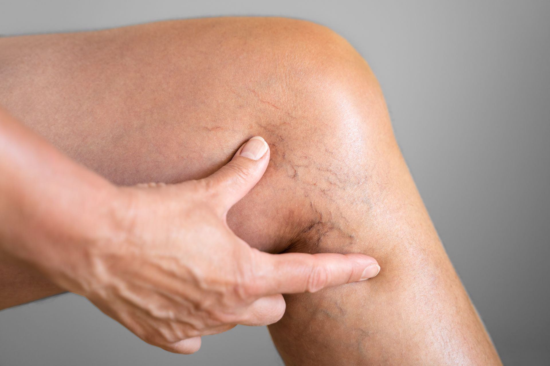 Hand pointing to visible spider veins on a leg, highlighting an area for treatment.