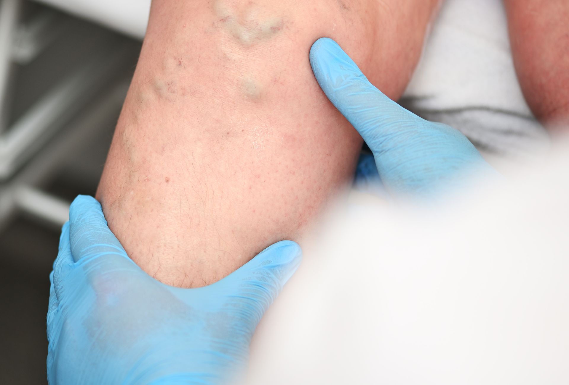 Clinician examining varicose veins on a patient's lower leg.