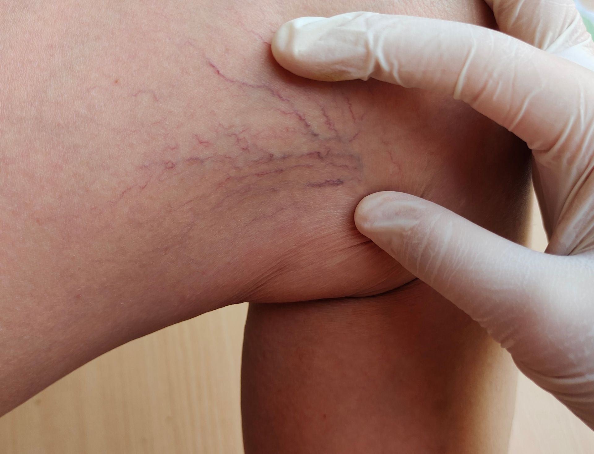 Gloved clinician examining visible varicose veins on a patient's lower leg.