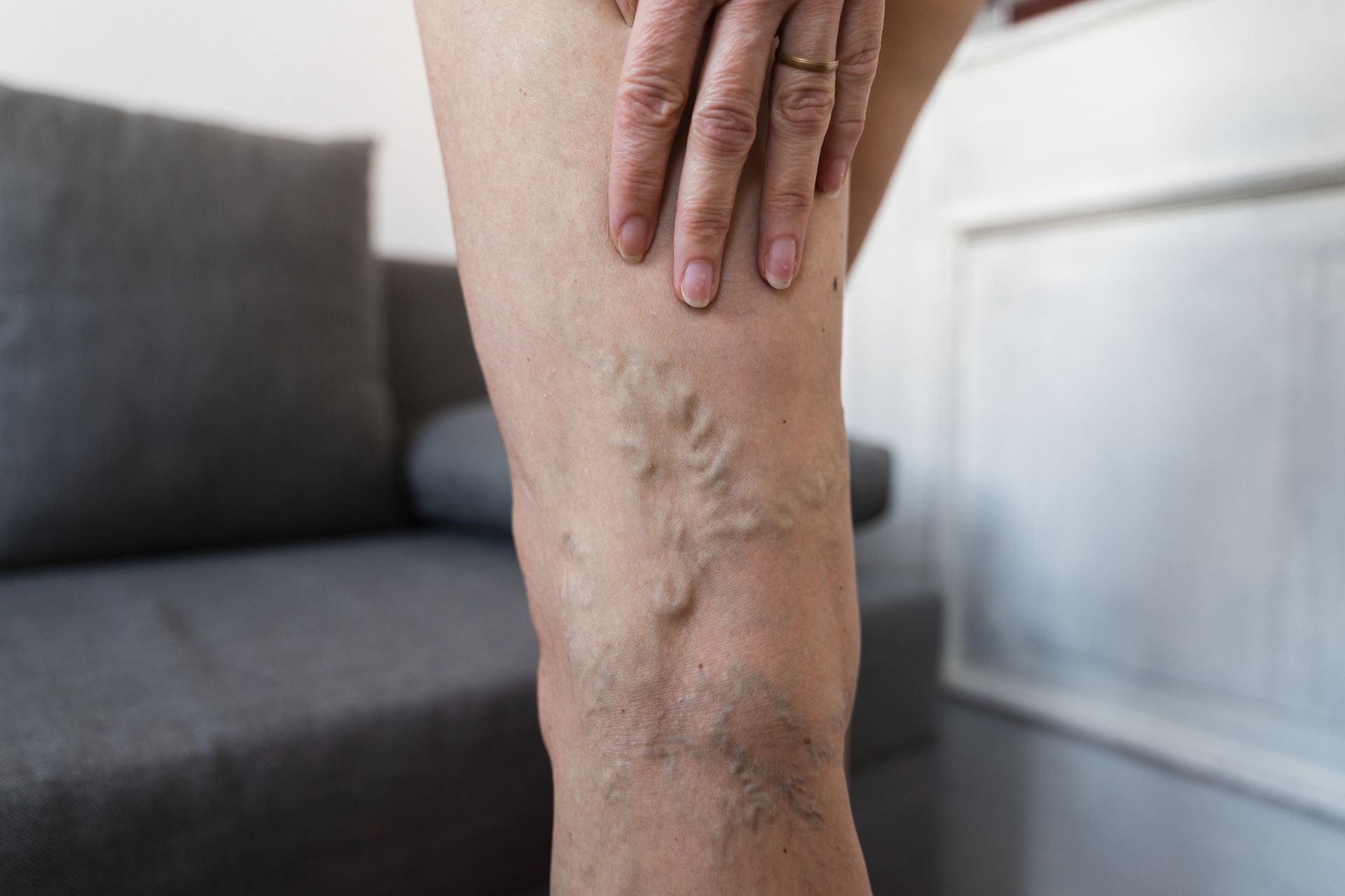Close-up of a person's leg with varicose veins and hand resting on it.