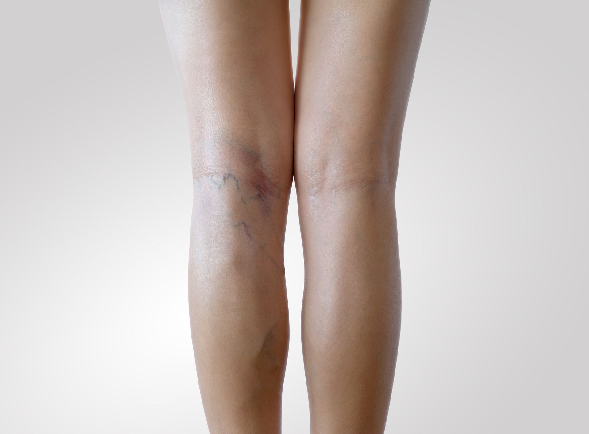 Close-up of legs with varicose veins on one knee. Close-up of legs with varicose veins on one knee.