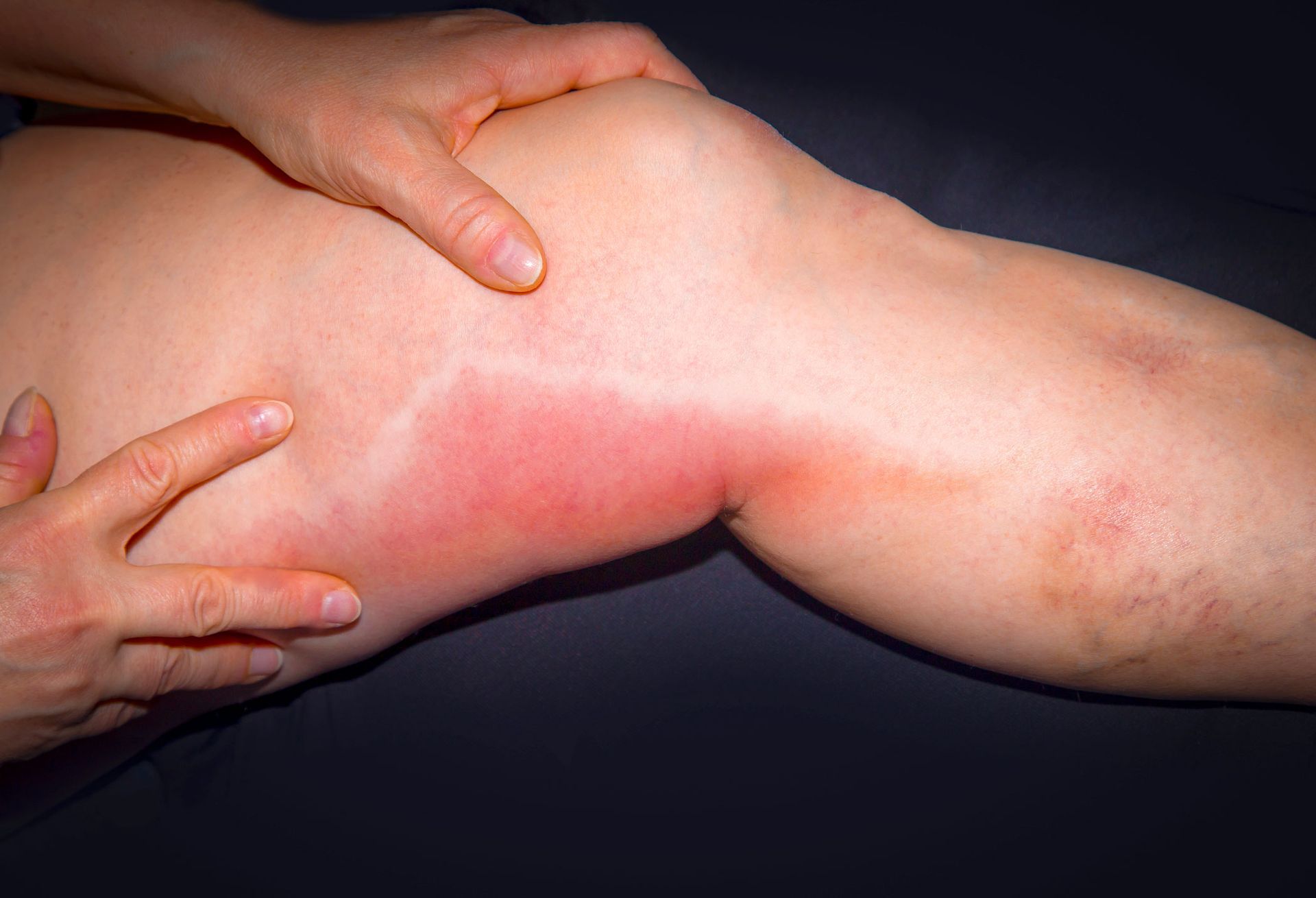 A close up of a person's leg with inflammation.