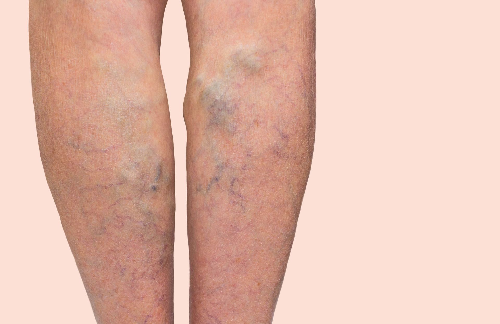 A close up of a person's legs with varicose veins.