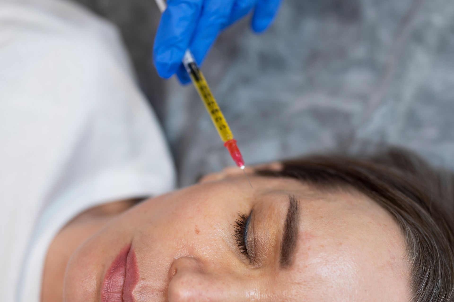 A woman is getting a biostimulator injection in her forehead.
