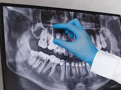 An x-ray being reviewed, showing an unerupted tooth.