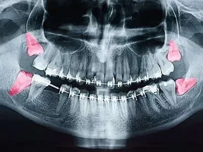 A panoramic dental x-ray with the four wisdom teeth highlighted.