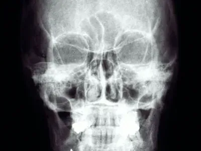 A panoramic dental x-ray with the four wisdom teeth highlighted.