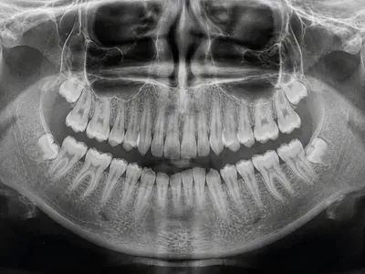 An extracted tooth held in a gloved hand.