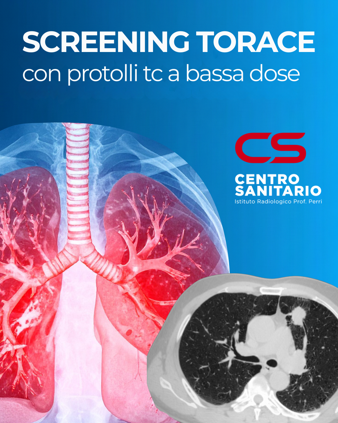 esame TC del torace con protocolli bassa dose per screening tumore polmonare
