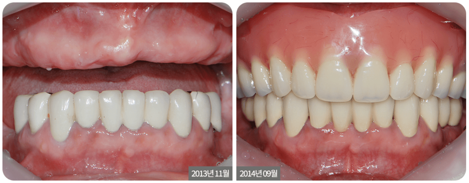 Two sets of dentures, upper and lower, displayed to show before and after. The dentures are white and the gums are pink.