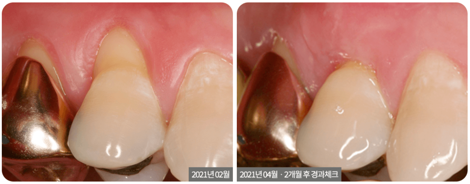 Dental images of teeth with gold crowns and a comparison of the teeth before and after a procedure, showcasing the teeth and gums.