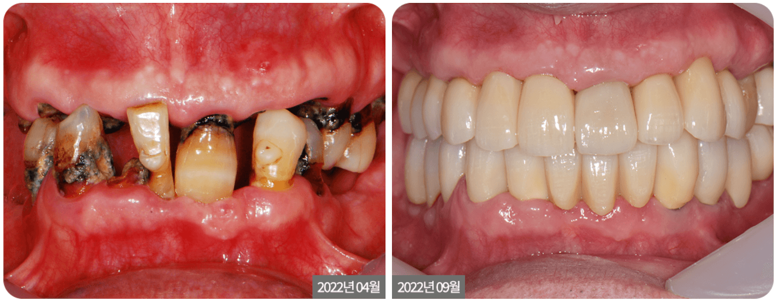 Before and after photos of dental work. The first shows damaged teeth, the second shows a healthy smile with white teeth.