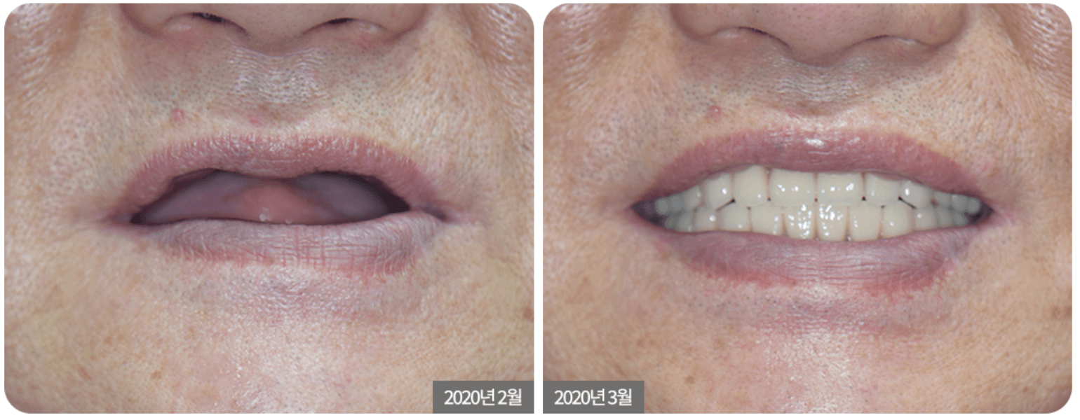 Close-up of a person's mouth before and after a dental procedure. The 
