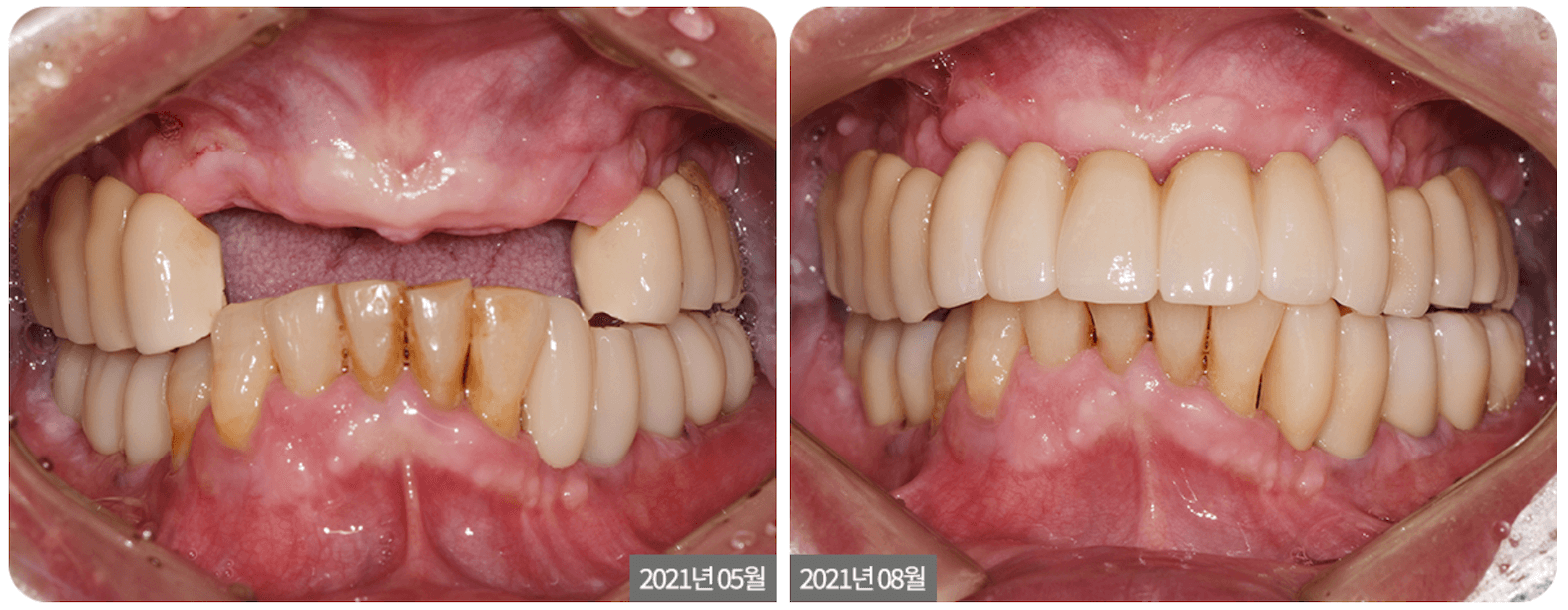 Before and after dental work: showing missing teeth replaced with new, white crowns.