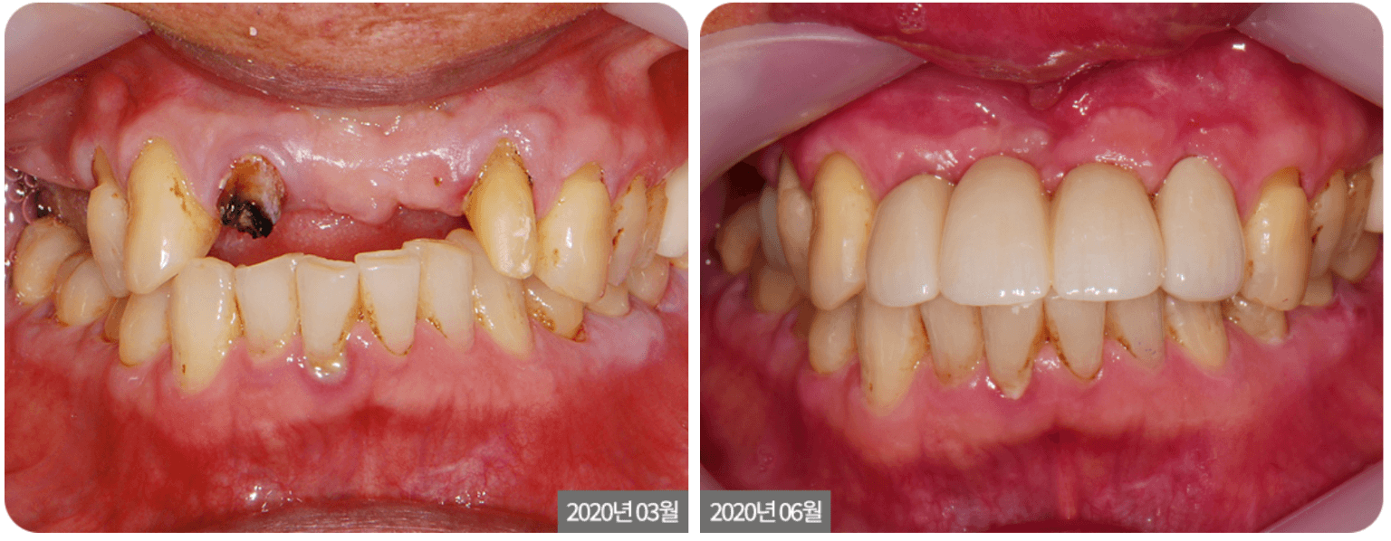 Dental before-and-after showing a mouth with decayed and missing teeth on the left, and a set of completed dental implants on the right.