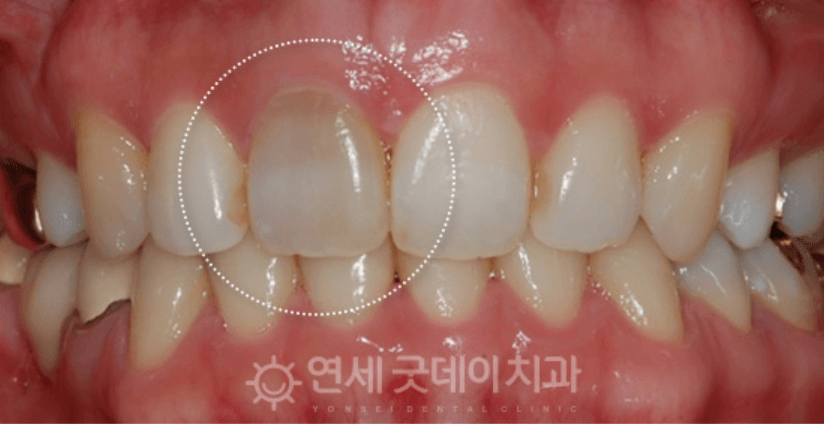 Close-up view of teeth with one tooth, circled, appearing discolored. The tooth is a lighter shade of white compared to the surrounding teeth.