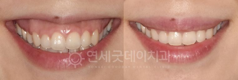Before and after comparison of teeth. The