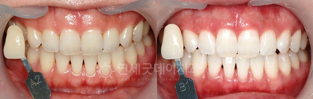 首爾江南牙科牙色比對板展示,牙齦粉紅、牙齒潔白。