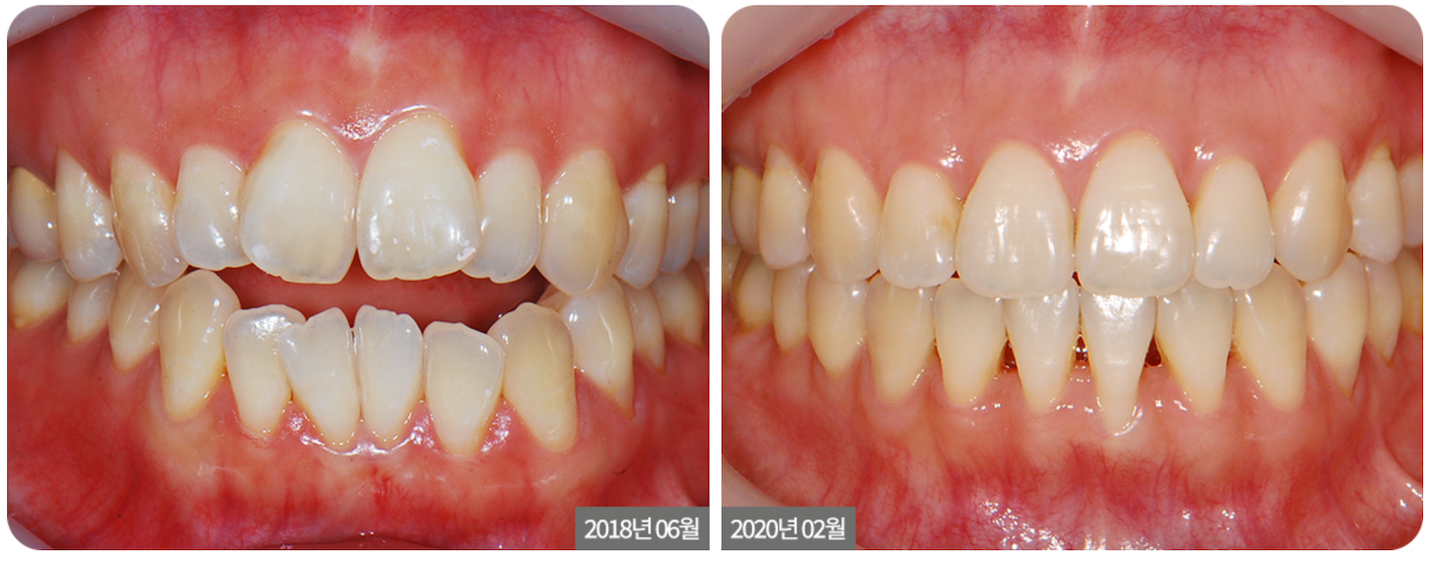 Two side-by-side photos showing a before-and-after comparison of teeth, likely after orthodontic treatment. The teeth are straighter in the second photo.