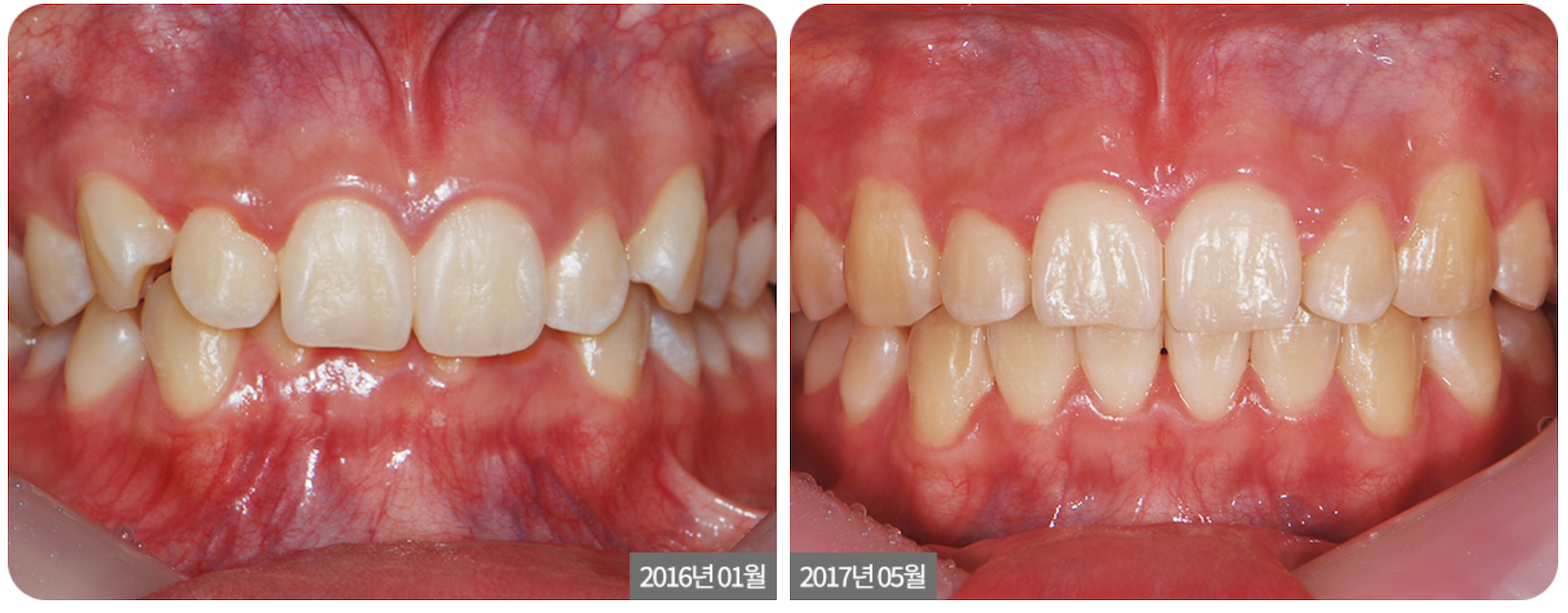 Side-by-side comparison of teeth. The left shows crooked teeth, and the right shows straightened teeth.