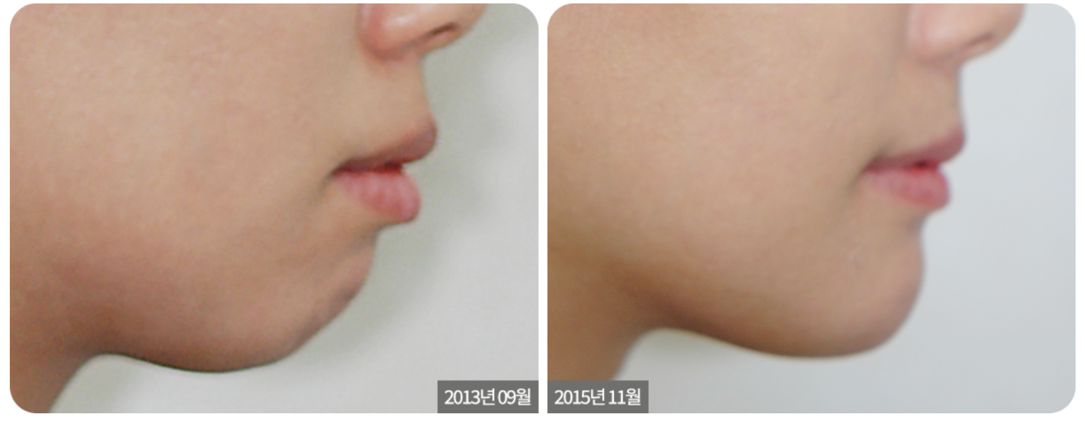 A side-by-side comparison of a person's profile before and after a cosmetic procedure, likely targeting the chin.