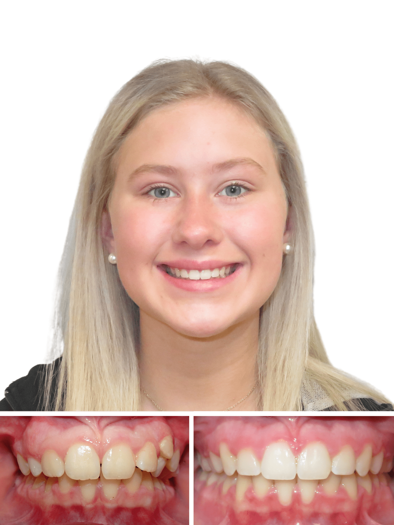 woman smiling after braces removed from our best orthodontist in Hickory nc