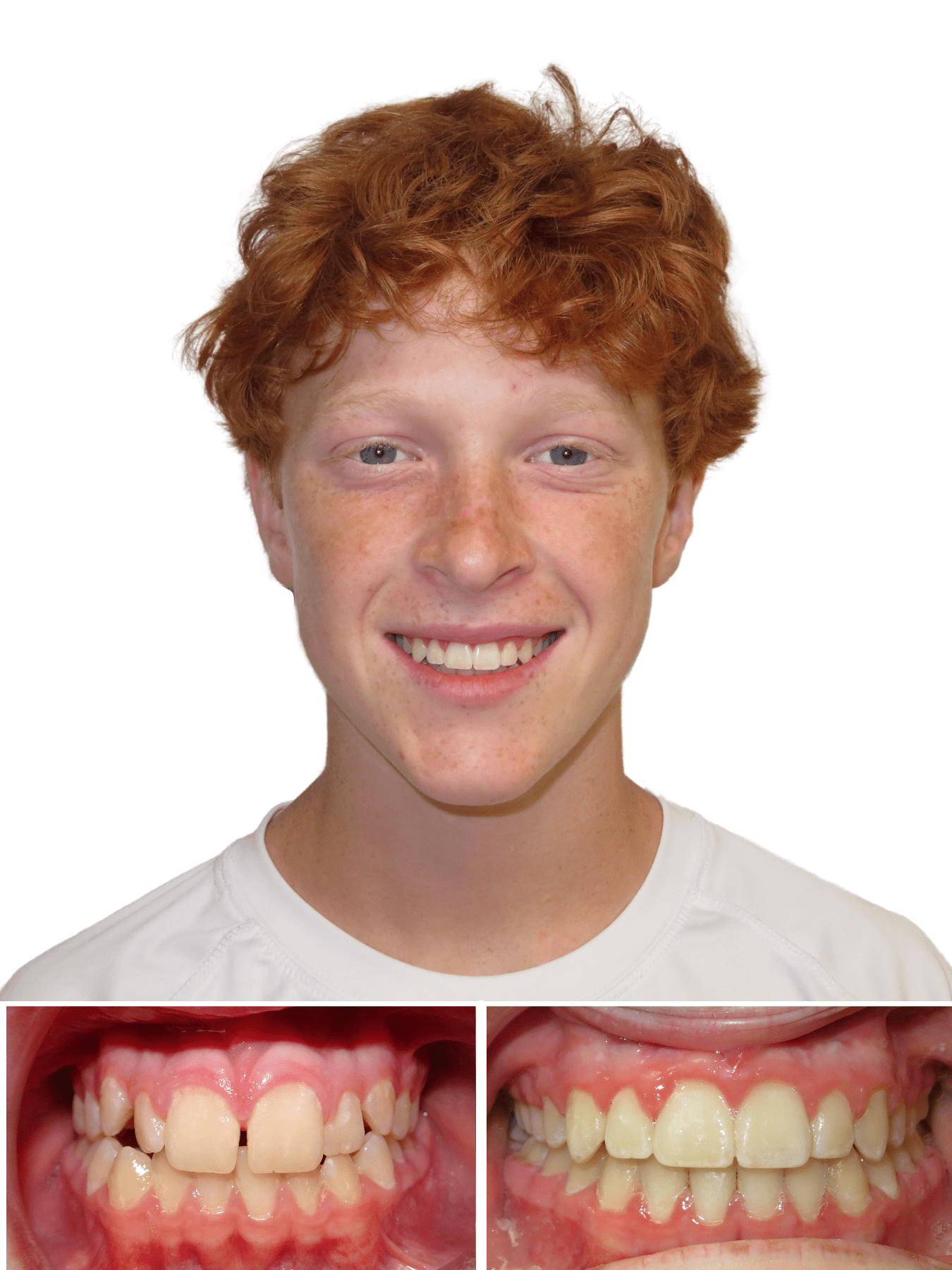 Teen boy smiling after braces from our top orthodontist in NC