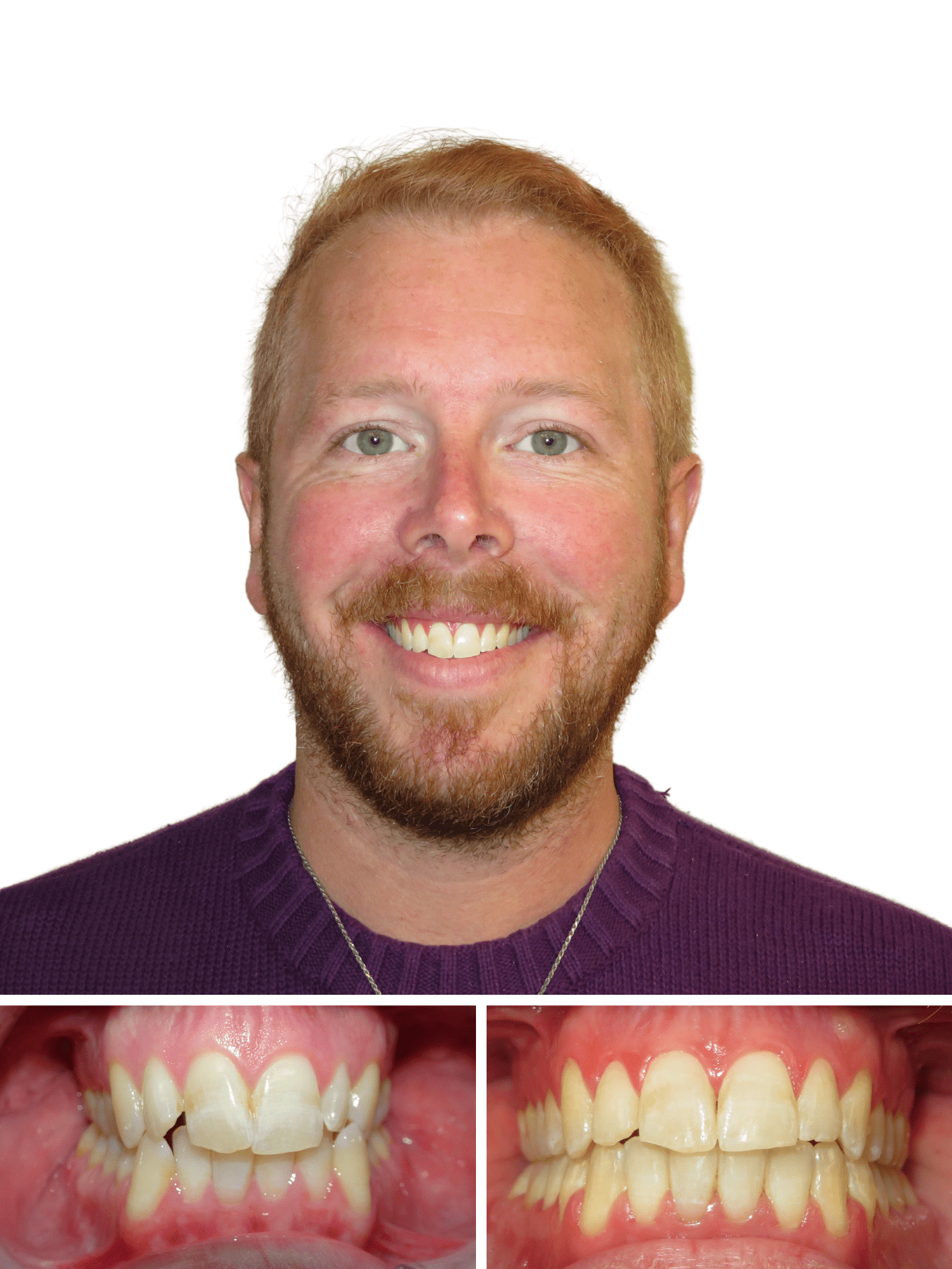 man smiling after cross bite fixed | Hickory NC