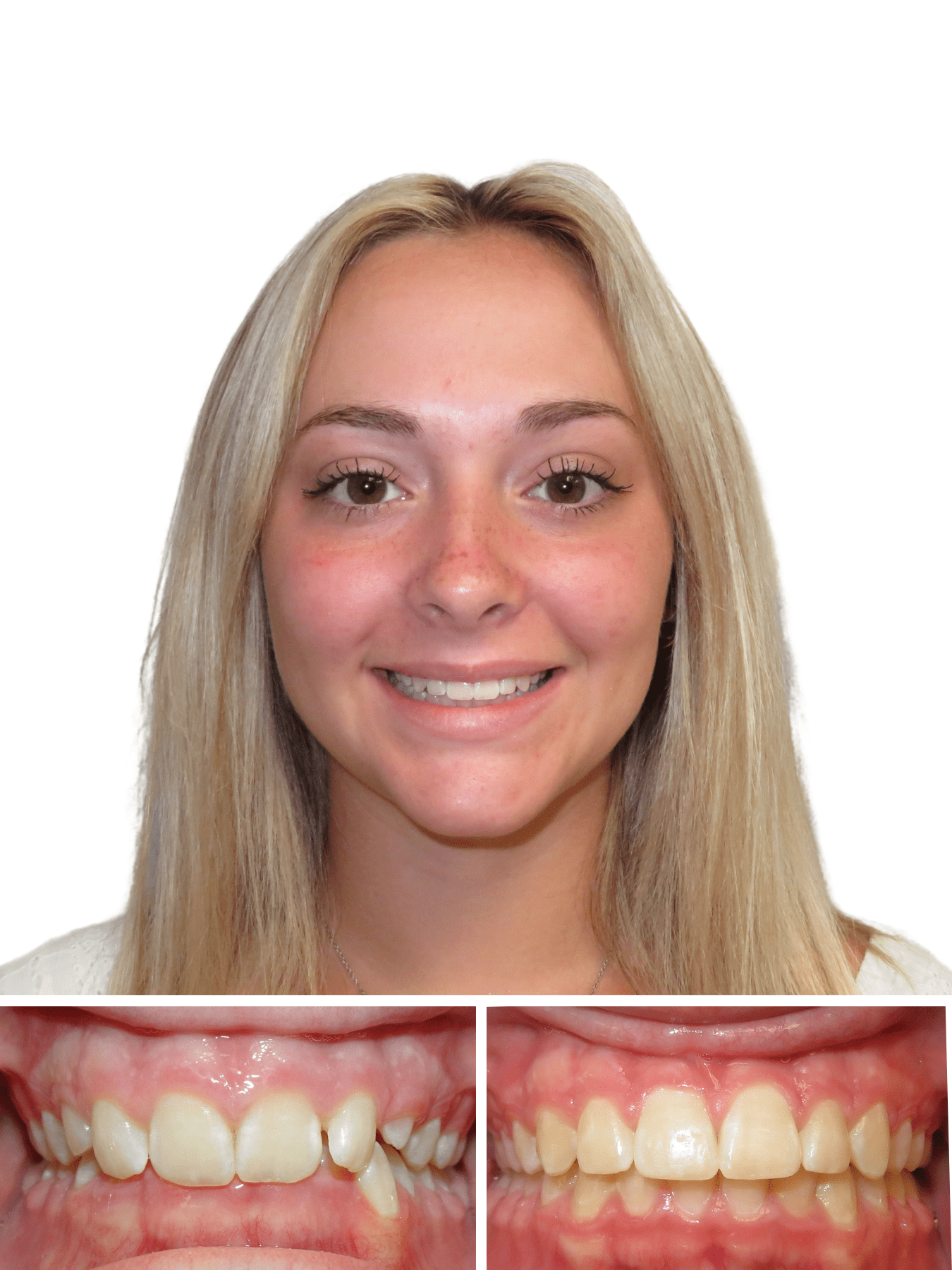 woman smiling | Fix your crossbite in Morganton NC