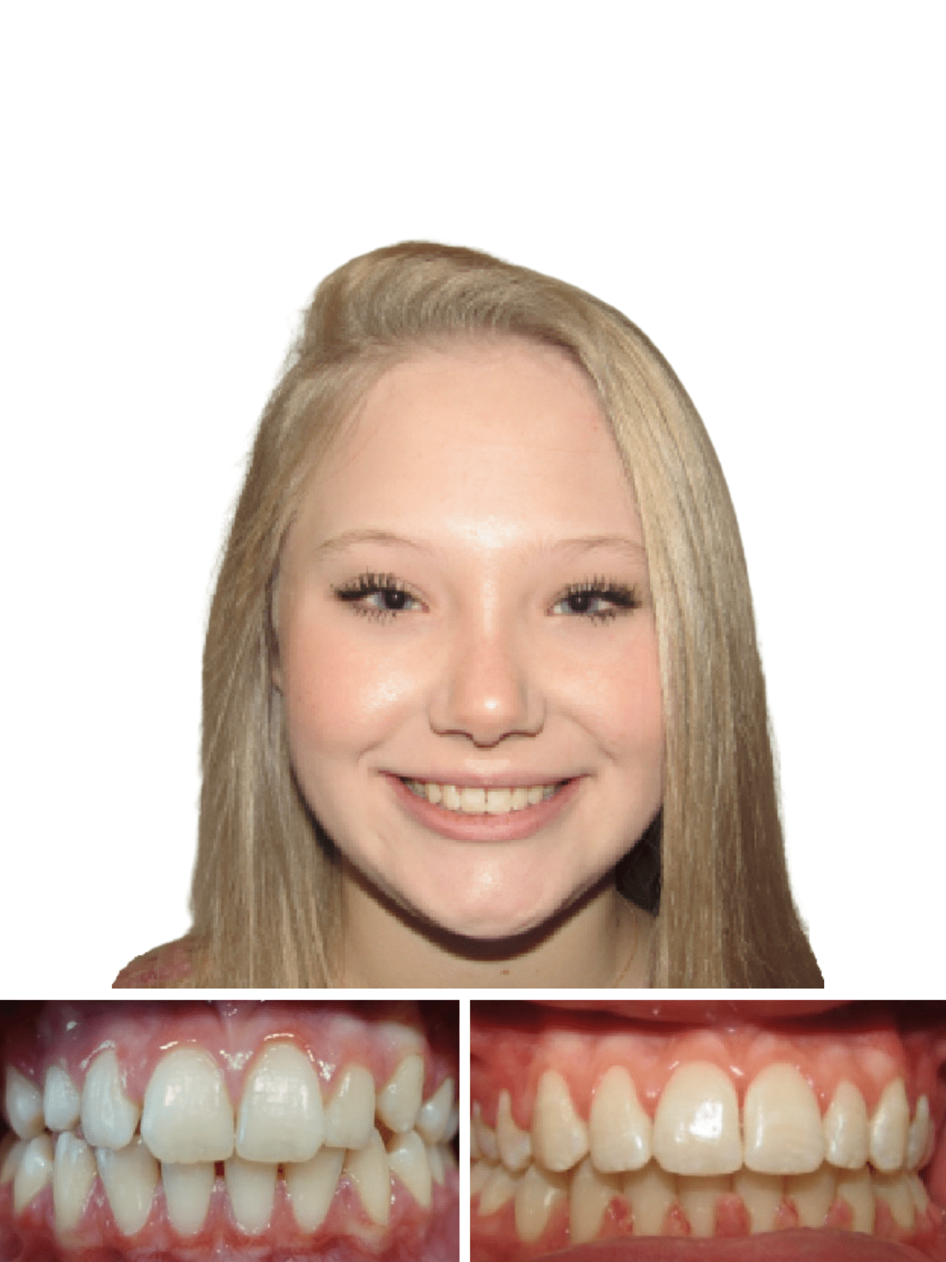 orthodontist patient happy after getting cross bite treatment in Hickory NC