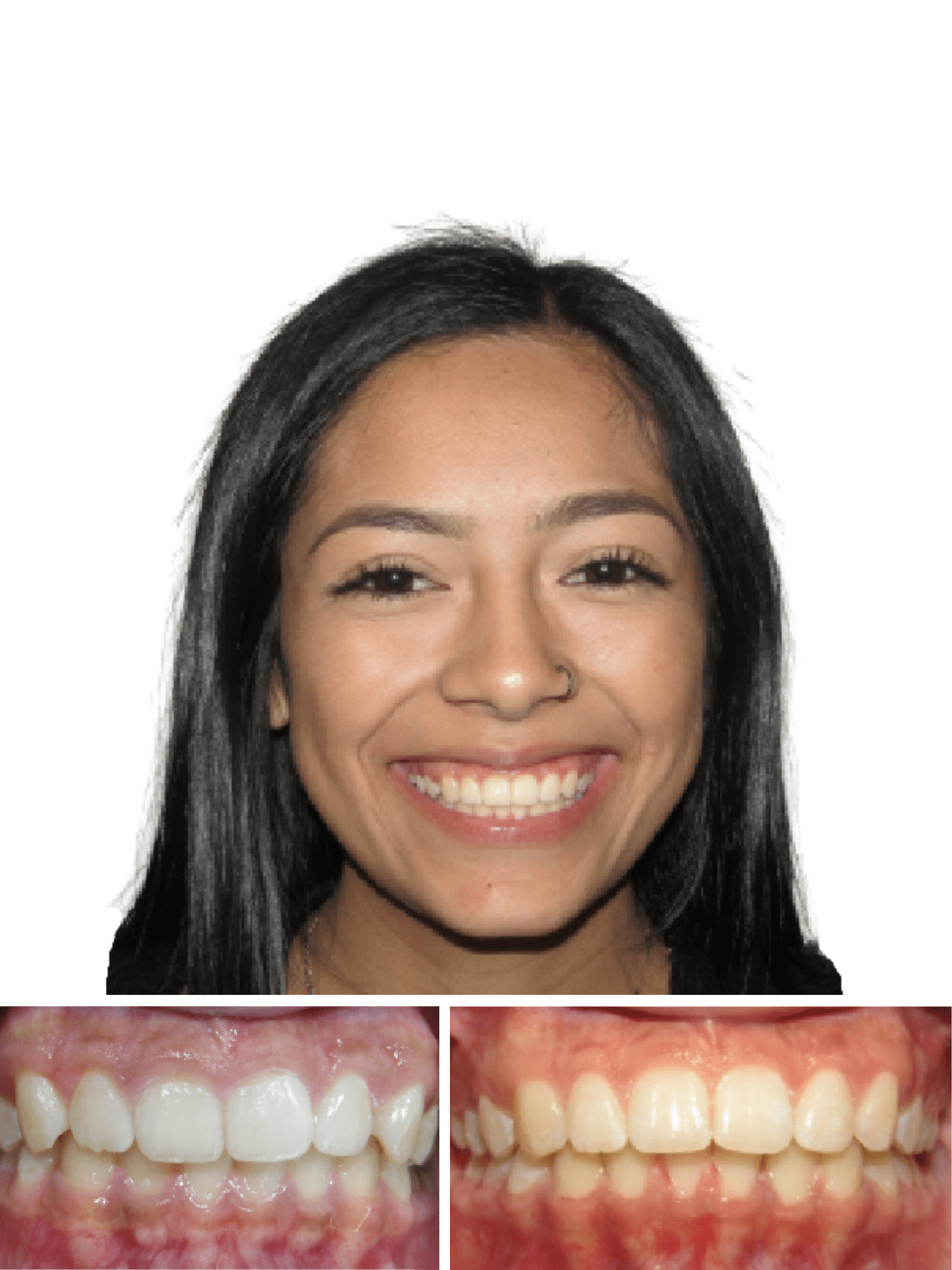 Woman smiling after getting retainers from our top orthodontist in Morganton NC