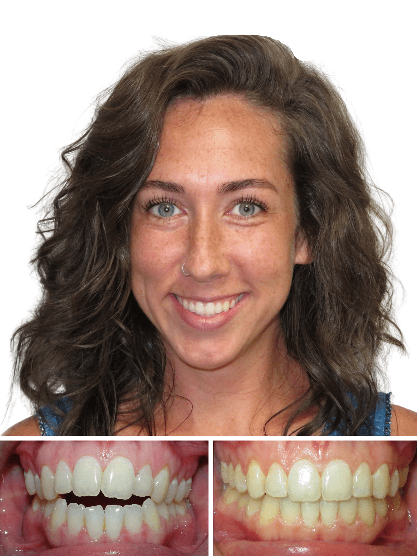 Smiling woman after getting her cross bite fixed | Hickory nc