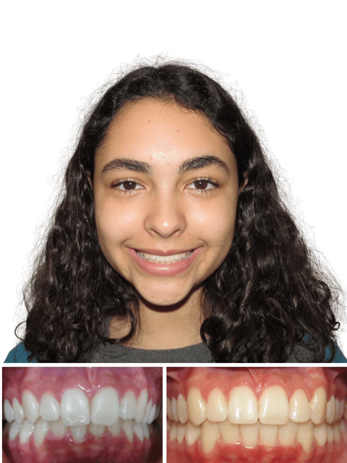 Teen smiling after braces with our best orthodontist in Hickory NC