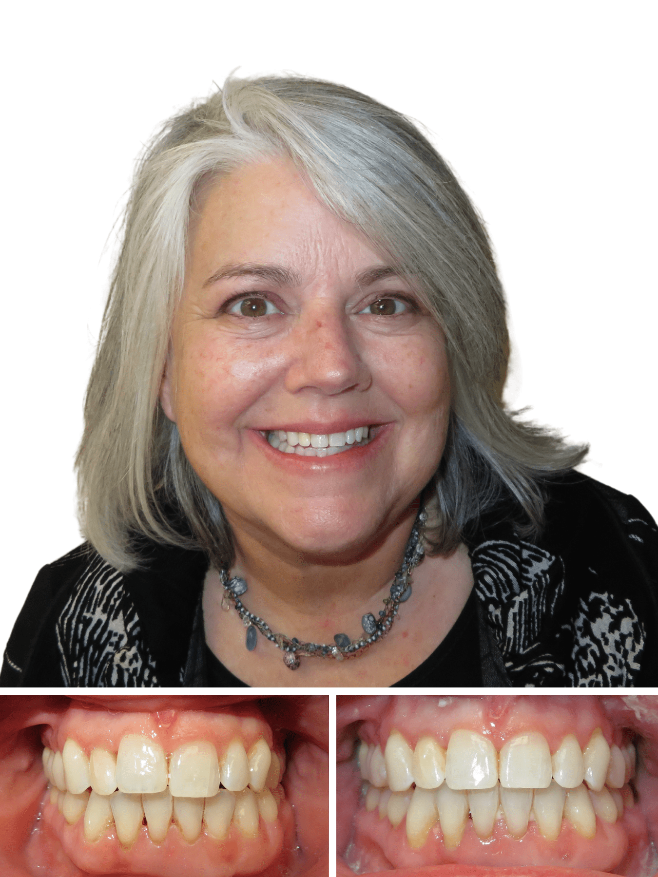 woman smiling after getting Invisalign treatments in Hickory NC