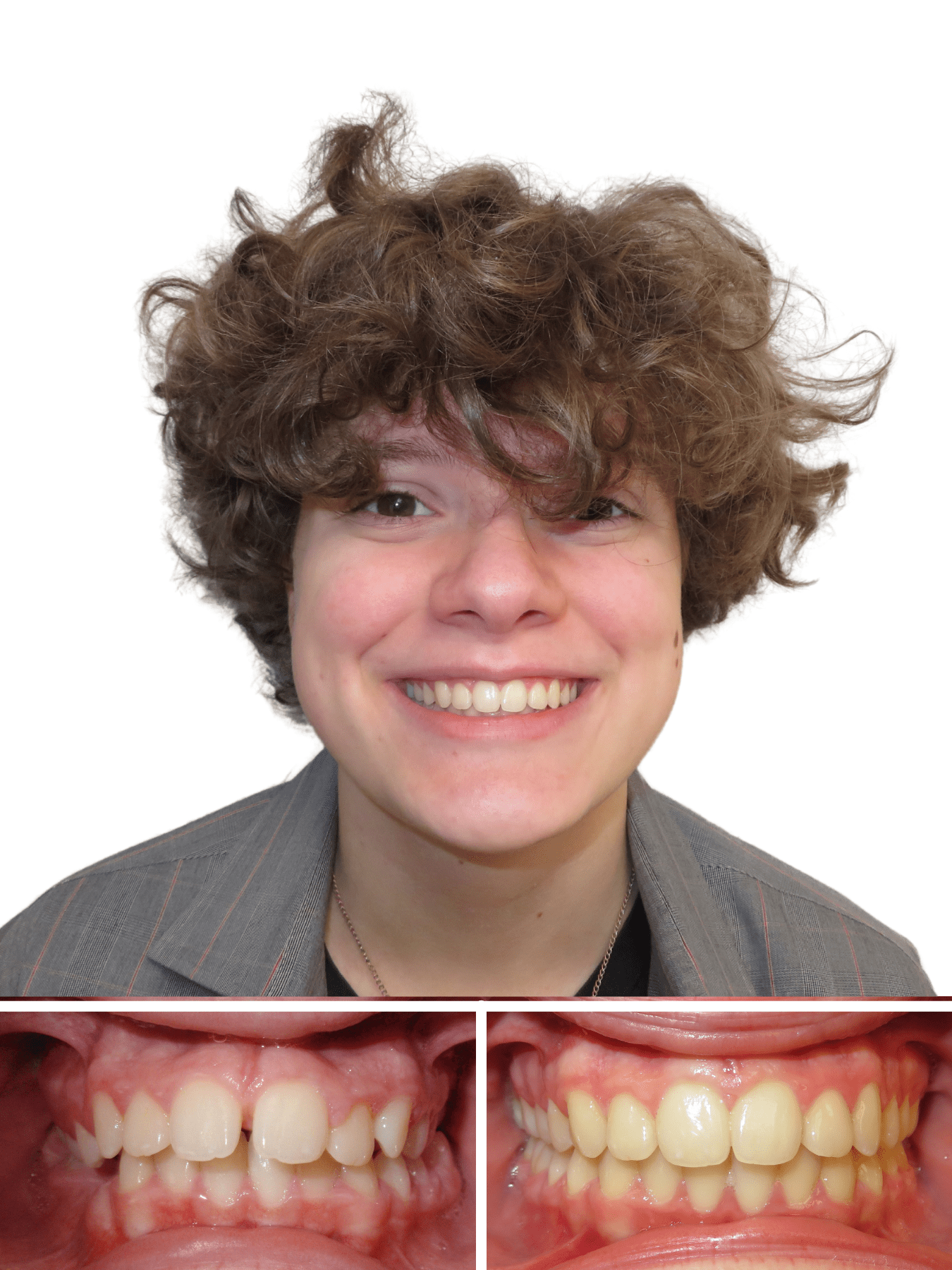 teen boy smiling after getting braces taken off | Orthodontist in Morganton NC