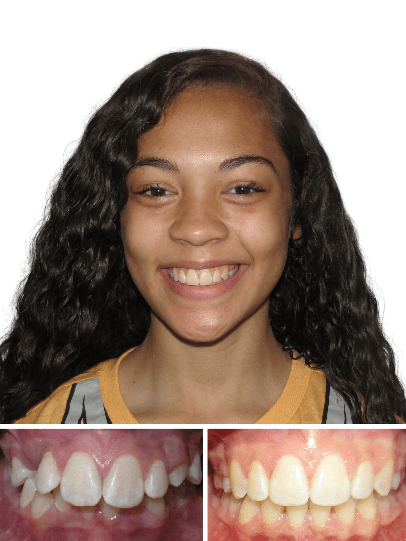 Happy dental patient after Invisalign treatments | Orthodontist in Hickory and Morganton NC