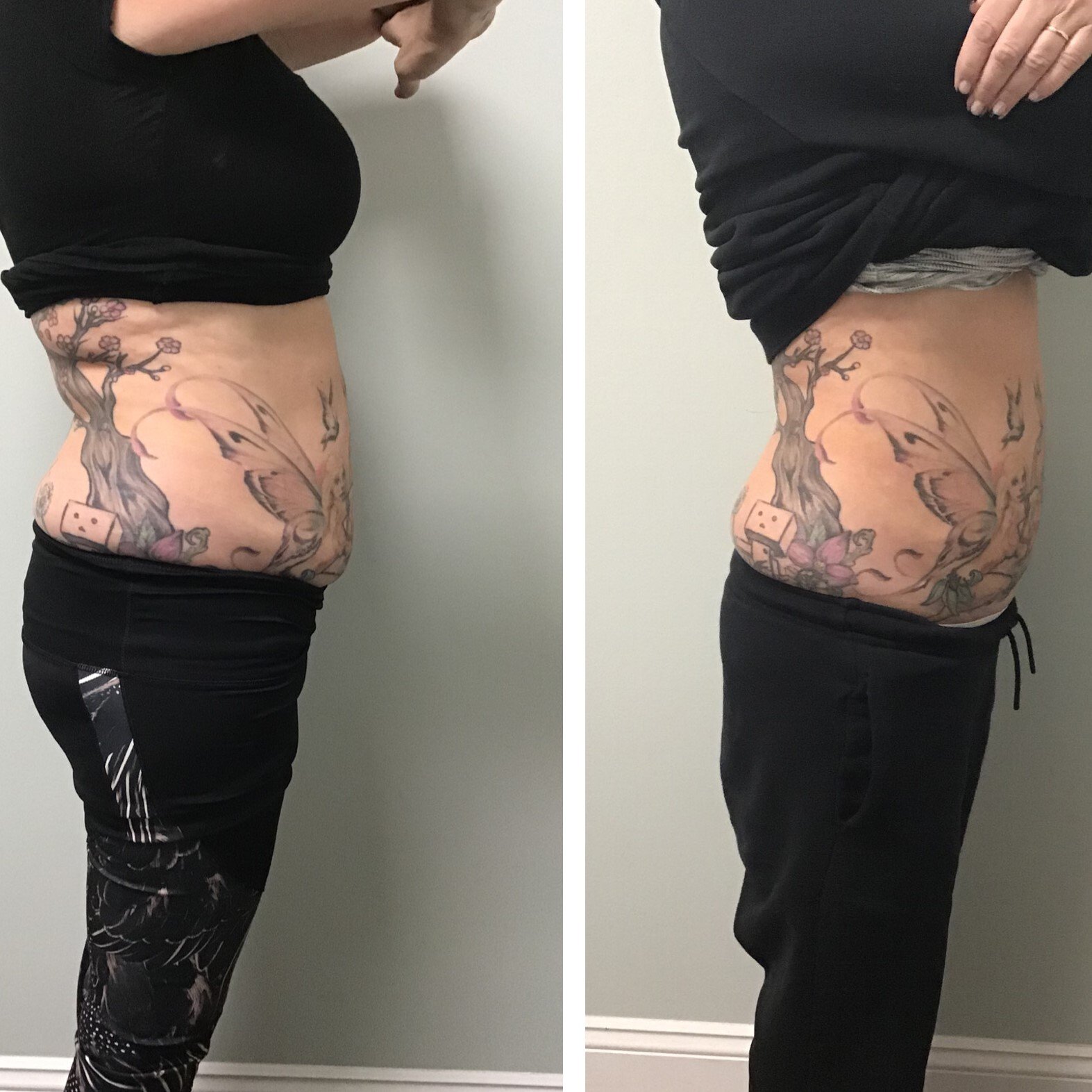 Pittsford Laser & Aesthetics Rochester, NY Laser Fat Reduction