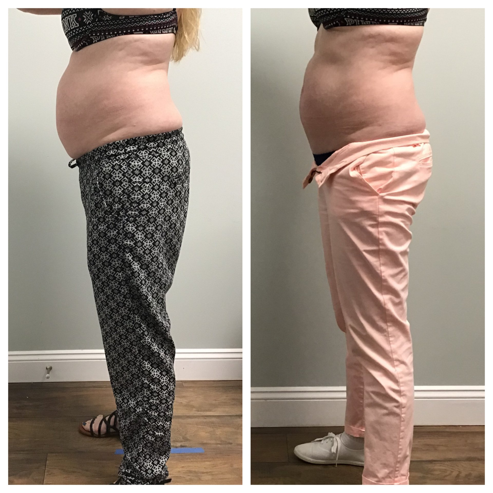 Pittsford Laser & Aesthetics Rochester, NY Laser Fat Reduction