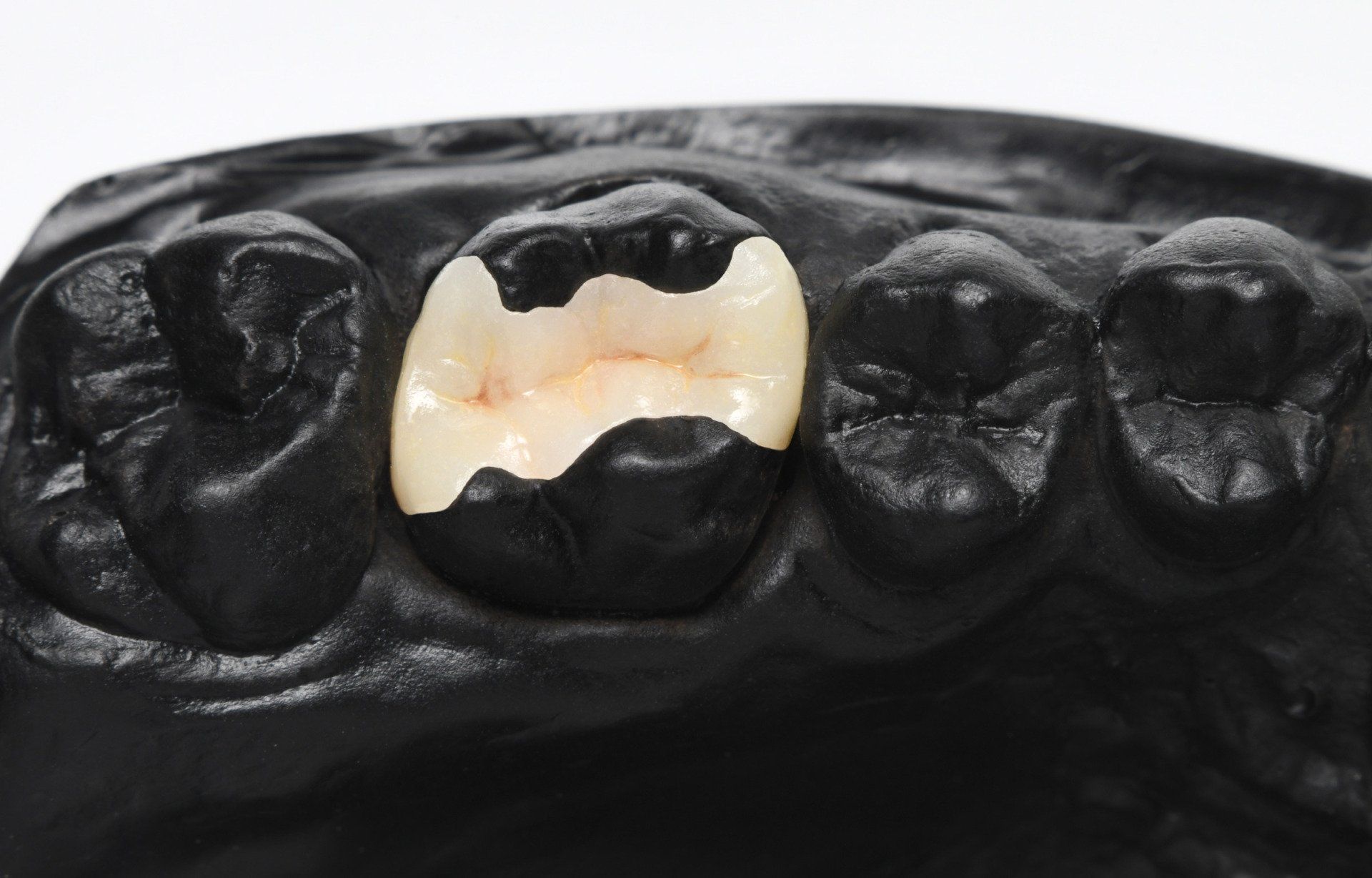Demonstration of tooth filling